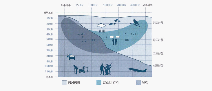 난청의 종류와 정도 그래프