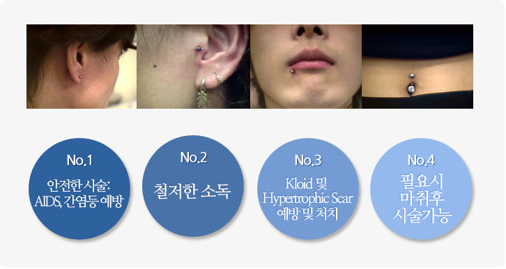 1. 안전한시술:AIDS, 간염등 예방 2.철저한 소독 3.Kelsid 및 Hyperstrophic Scan예방 및 처치 4. 필요시 마취후 시술가능
